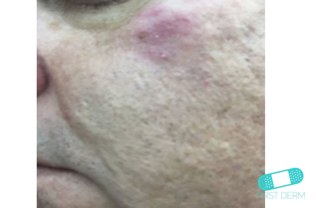 Rosacea Hudläkare på nätet