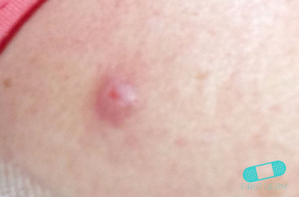 Online Dermatology Squamous Cell Carcinoma