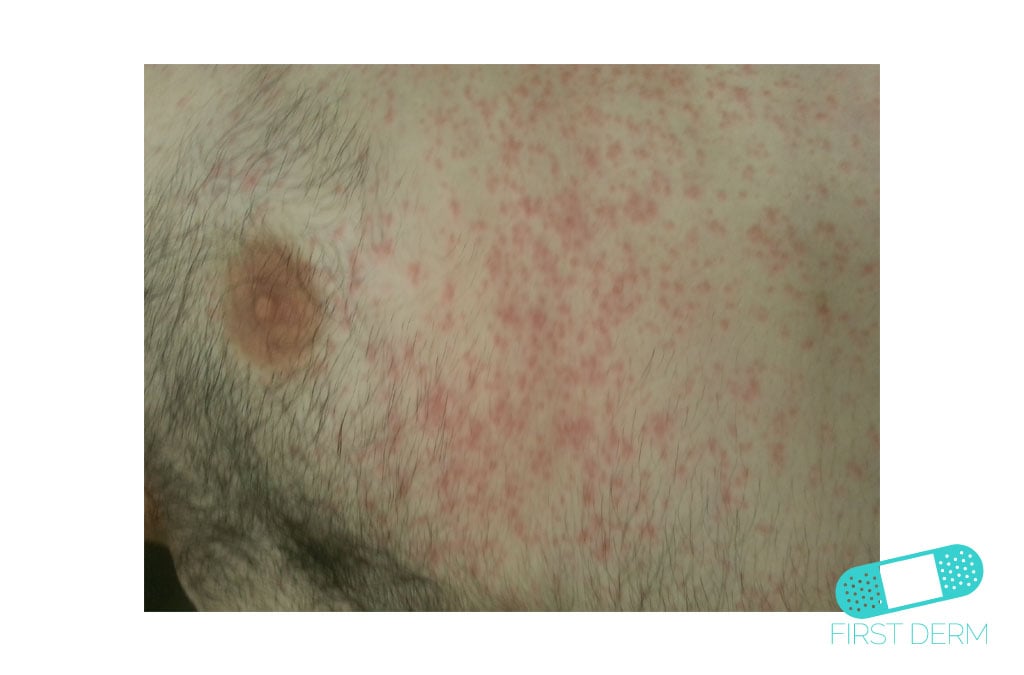 Online Dermatology Pitiriasis Versicolor (Tinea Verisicolor)