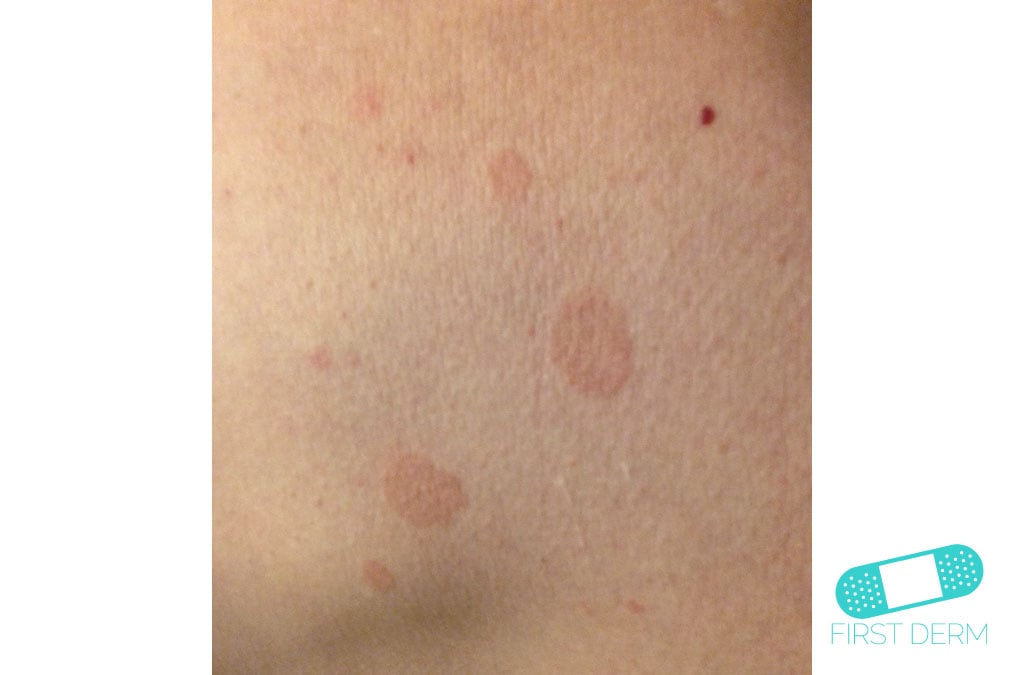 Online Dermatology Pitiriasis Versicolor (Tinea Verisicolor)