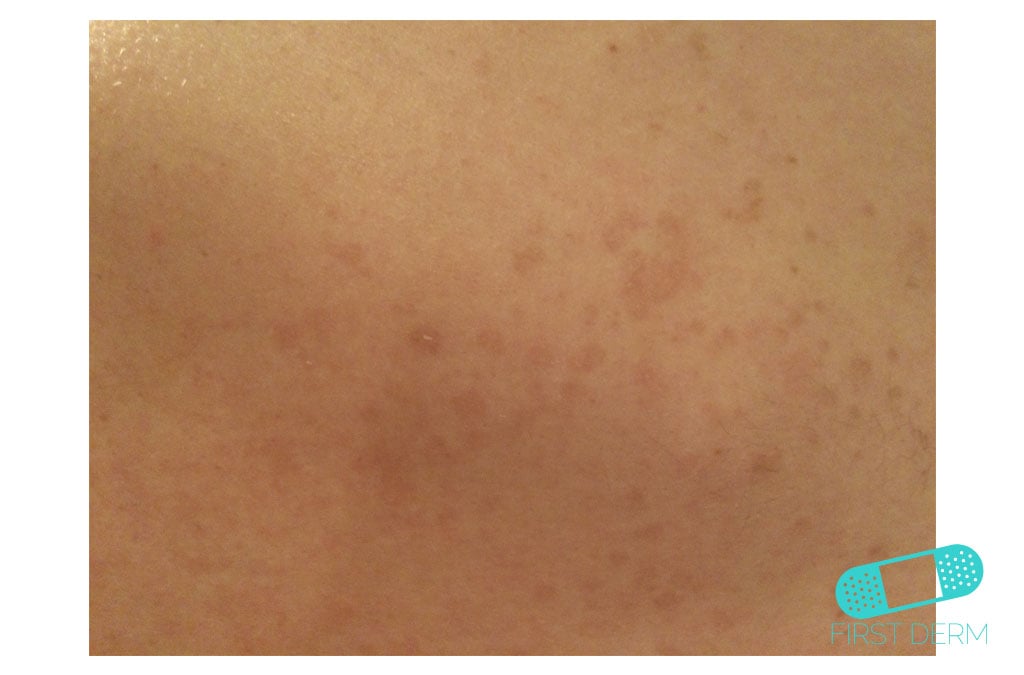 Online Dermatology Pitiriasis Versicolor (Tinea Verisicolor)