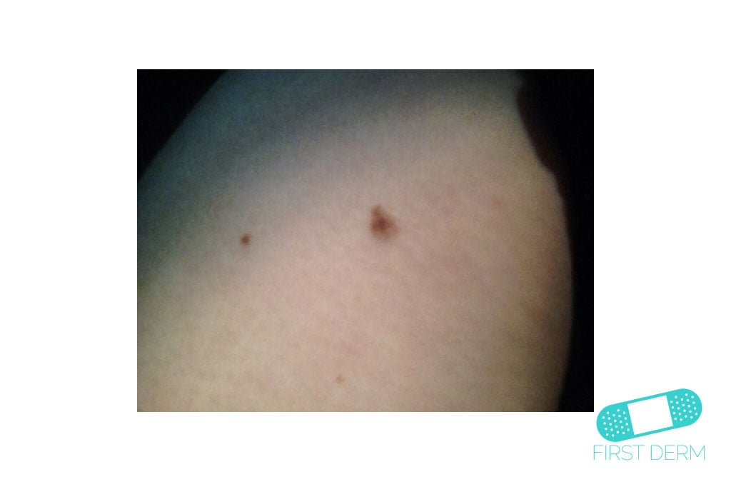 Online Dermatology Mole (Congenital nevus)