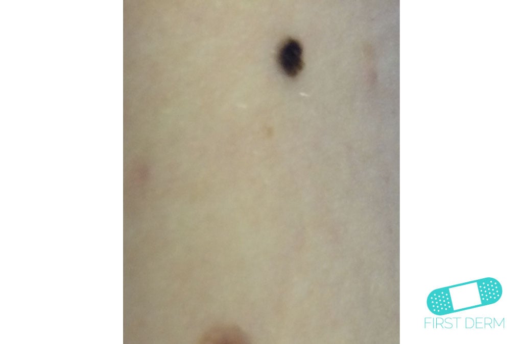 Online Dermatology Intradermal nevus