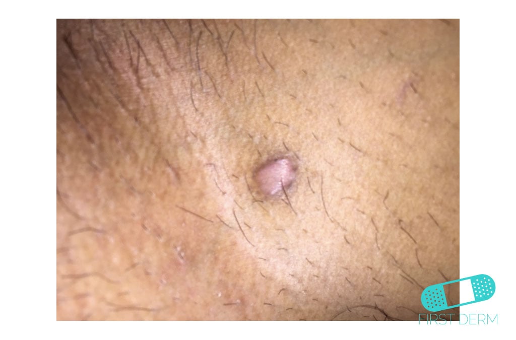 Online Dermatology Keloid (Hypertrophic Scar)