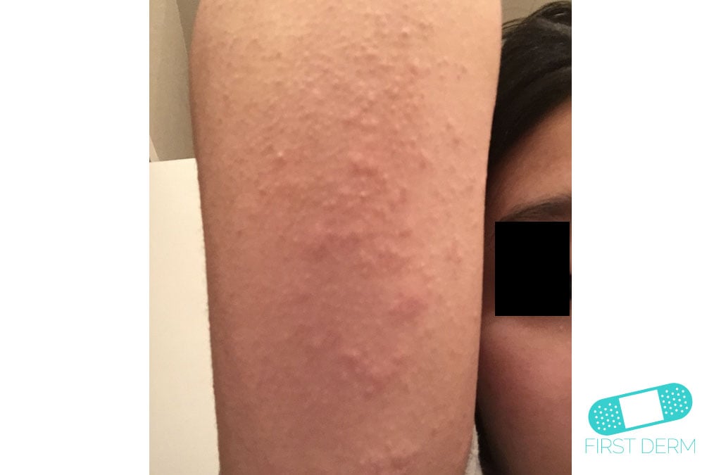Online Dermatology Keratosis Pilaris