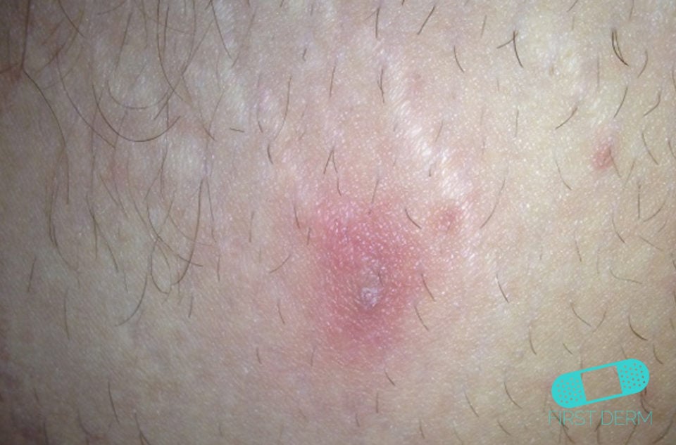 Abscess Online Dermatology