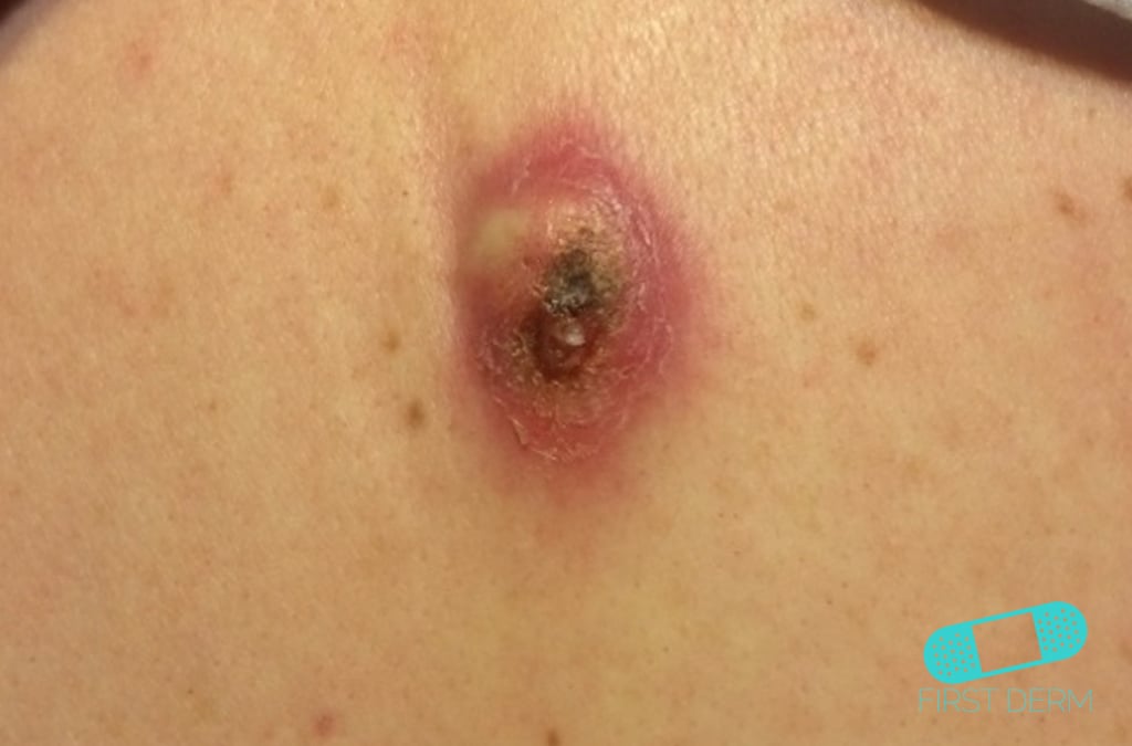 Online Dermatology Abscess