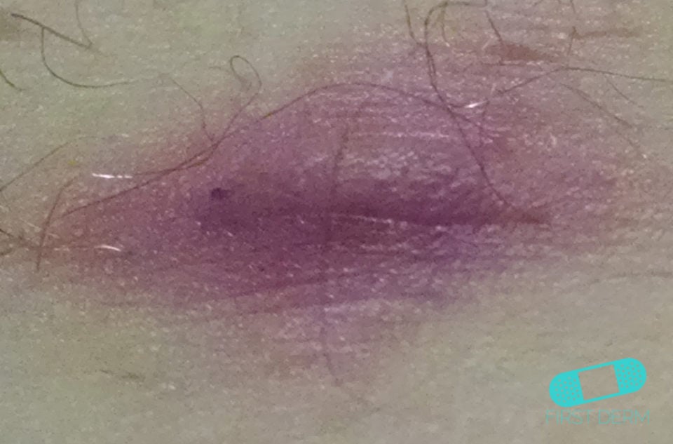 Abscess Online Dermatology