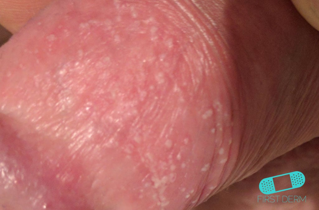 Online Dermatology Candidiasis (Cutaneous Candidiasis)
