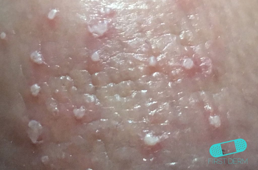 Online Dermatology Candidiasis (Cutaneous Candidiasis)