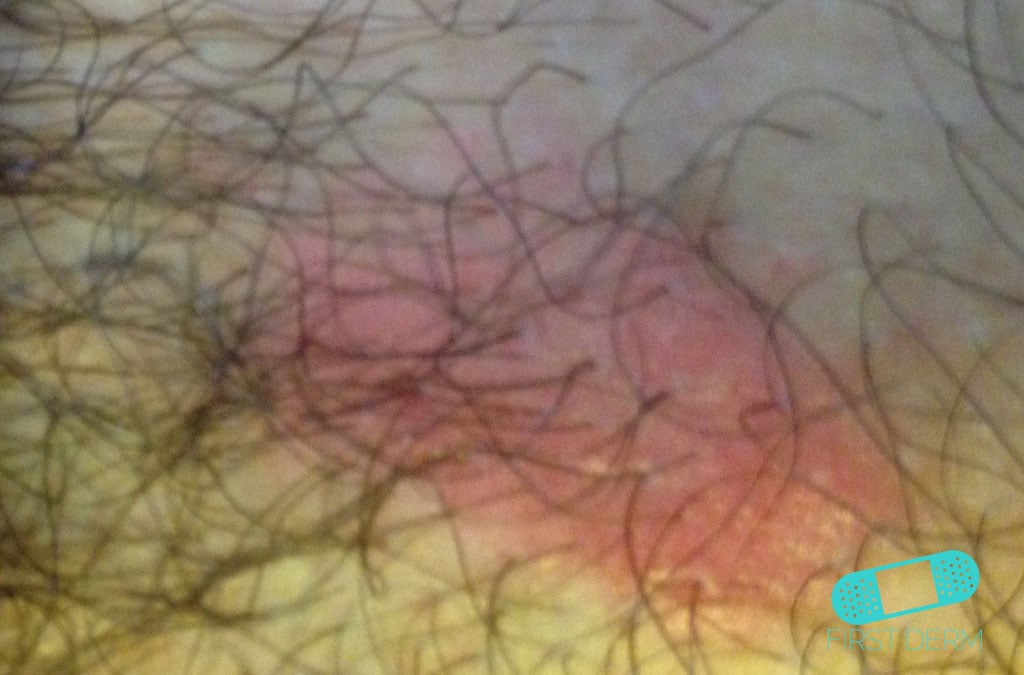 Vaginal Candidiasis Icd 10 / Life cycle of thrush. yeast infection rubbing alcohol