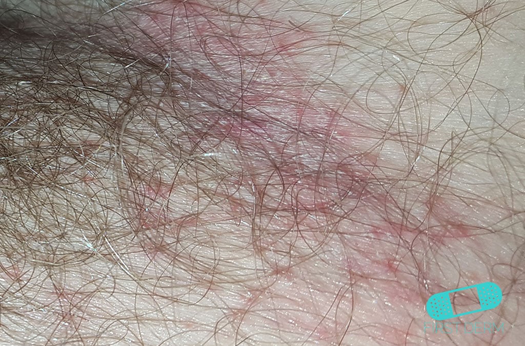 Online Dermatology Candidiasis (Cutaneous Candidiasis)