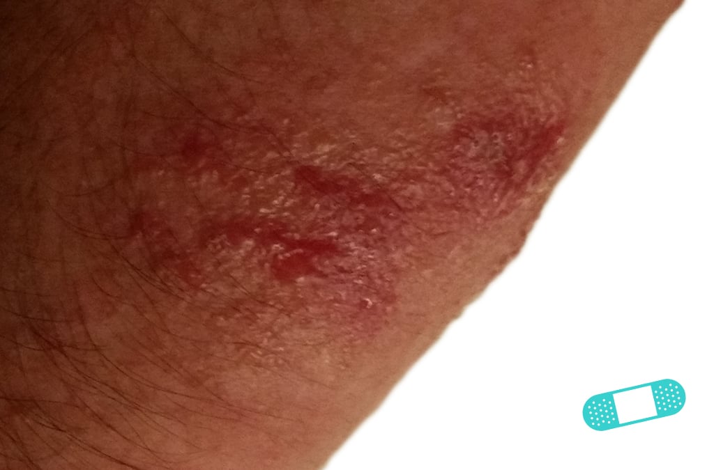 Online Dermatology Contact Dermatitis