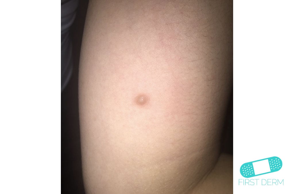 Online Dermatology Dermatofibroma