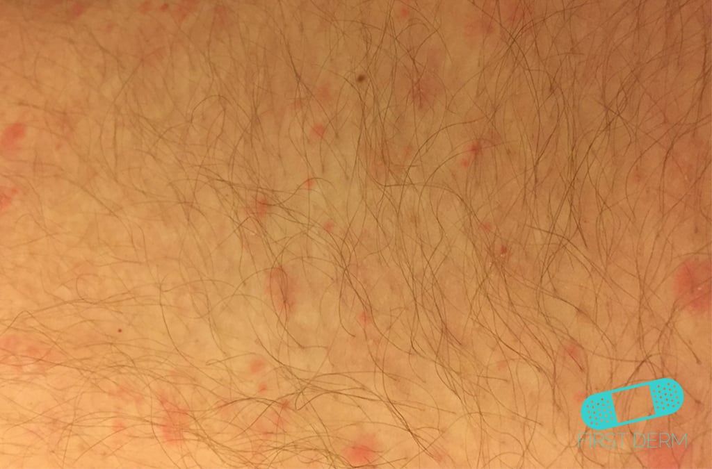 Follikulit (hårsäcksinflammation) Hudläkare på nätet First Derm