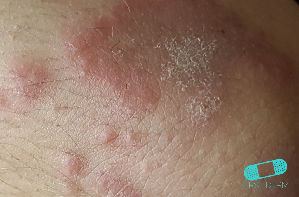 Yeast Fungal Skin Infection Skin infection pictures and treatments