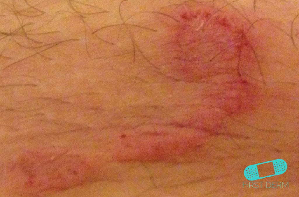 Online Dermatology Fungal infections