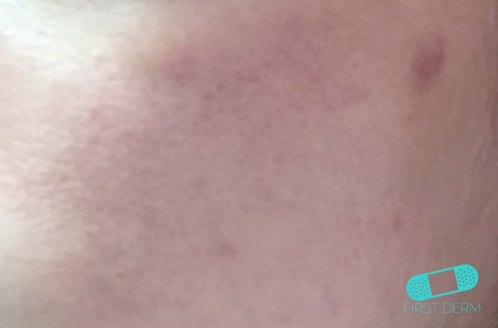Hudläkare på nätet Acne vulgaris (akne)