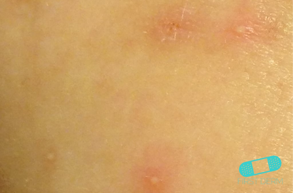 Hudläkare på nätet Acne vulgaris (akne)