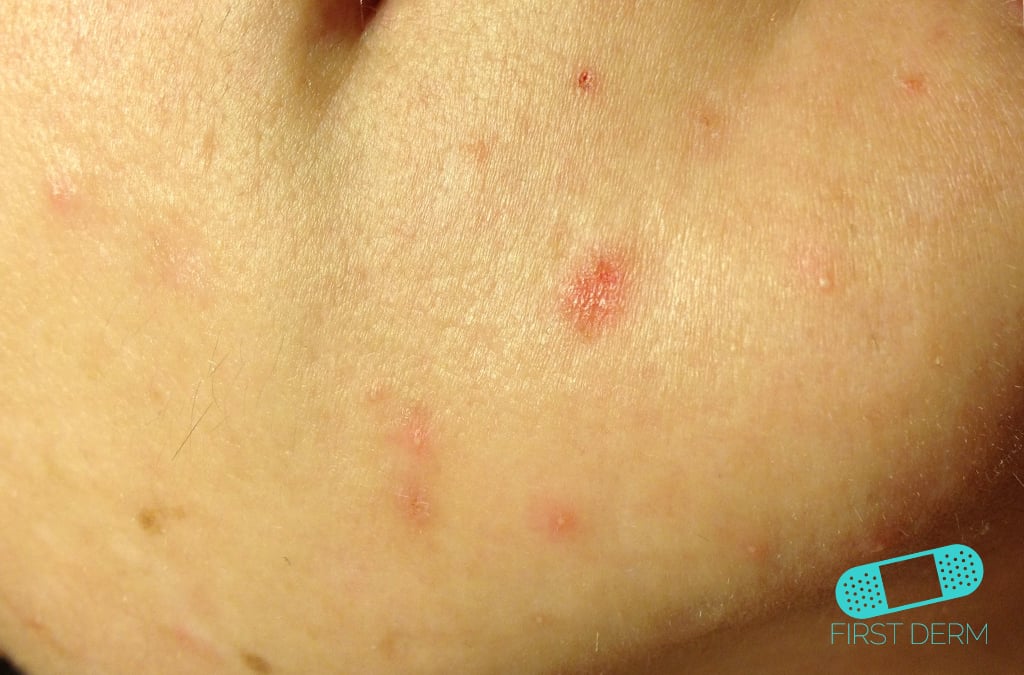 Hudläkare på nätet Acne vulgaris (akne)