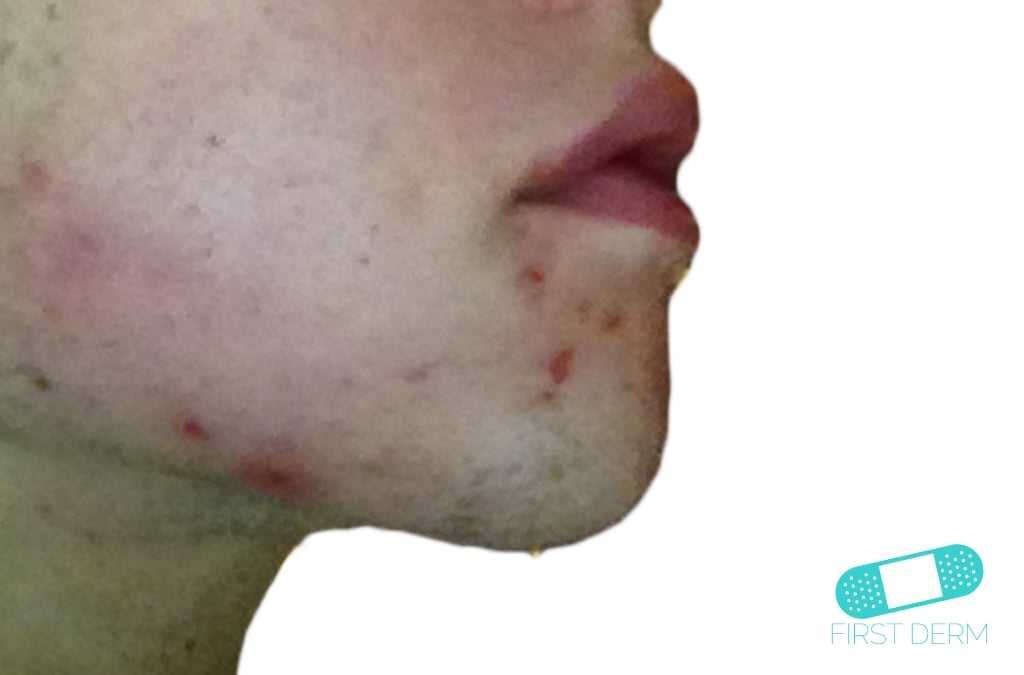 Hudläkare på nätet Acne vulgaris (akne)
