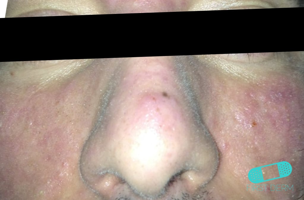 Hudläkare på nätet Acne vulgaris (akne)