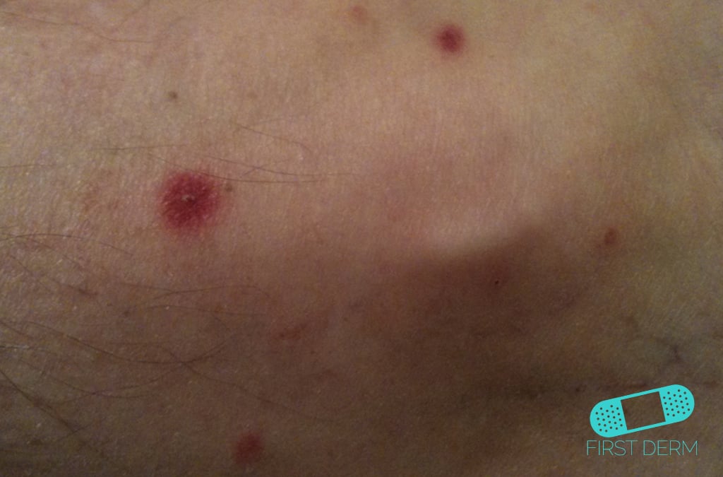 Hudläkare på nätet Acne vulgaris (akne)