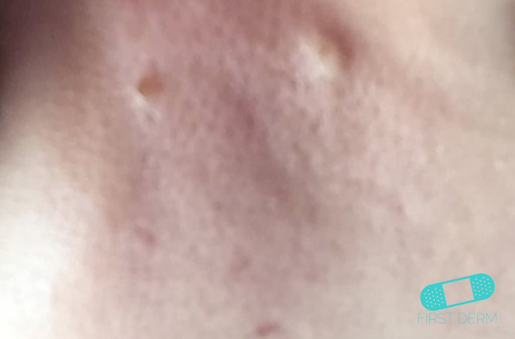 Hudläkare på nätet Acne vulgaris (akne)