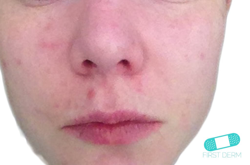 Hudläkare på nätet Acne vulgaris (akne)