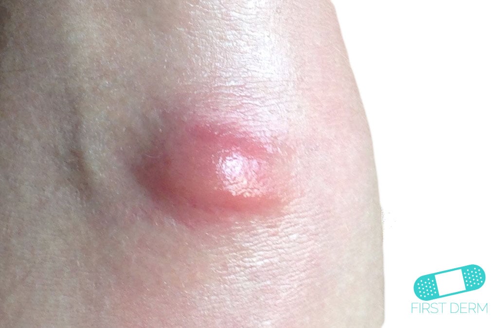 Online Dermatology Abscess
