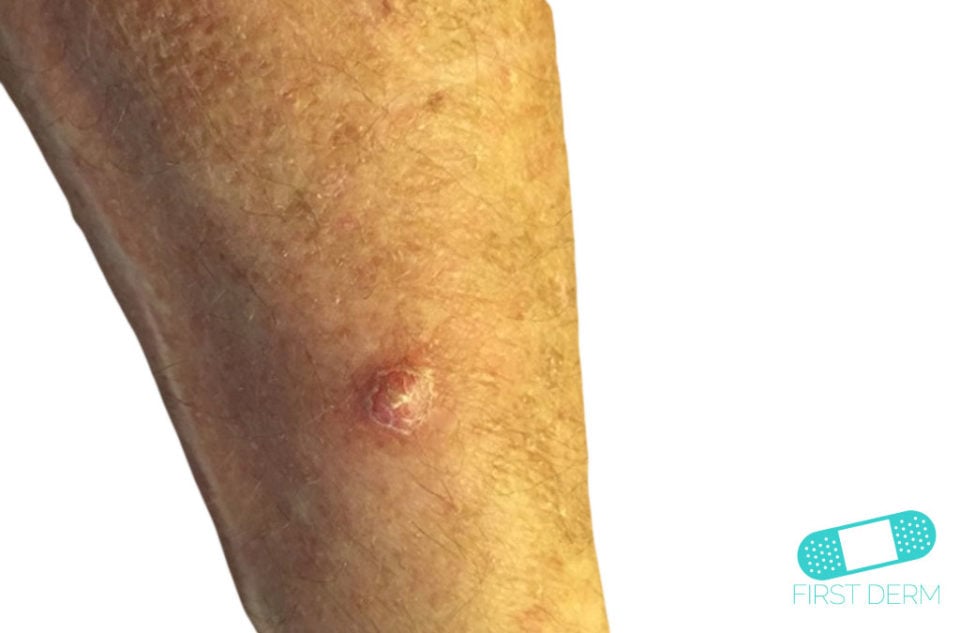 Abscess Online Dermatology