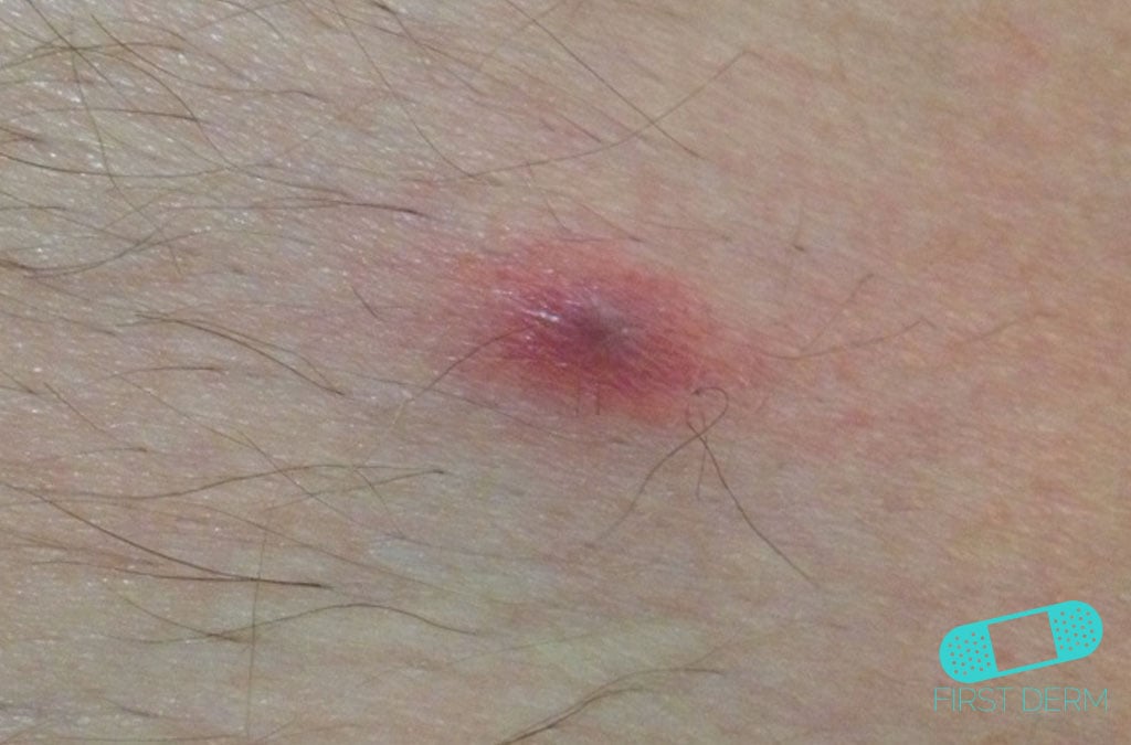 Online Dermatology Abscess