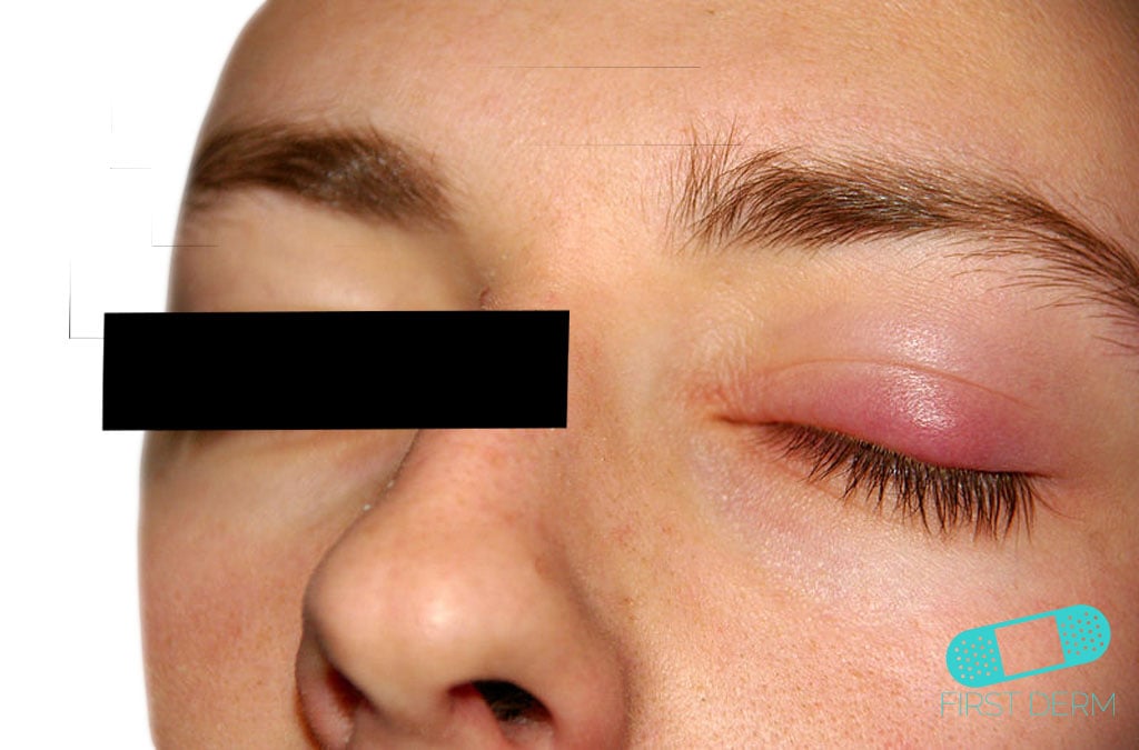 Online Dermatology Chalazion (Meibomian or Tarsal Cyst)