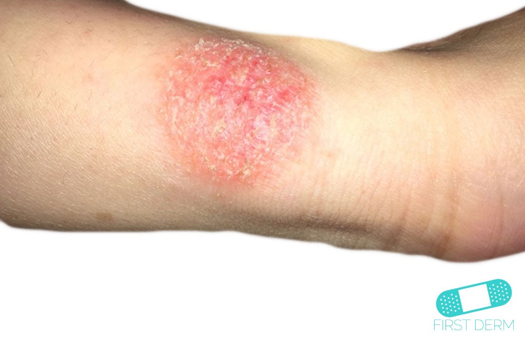 Online Dermatology Impetigo (School Sores)