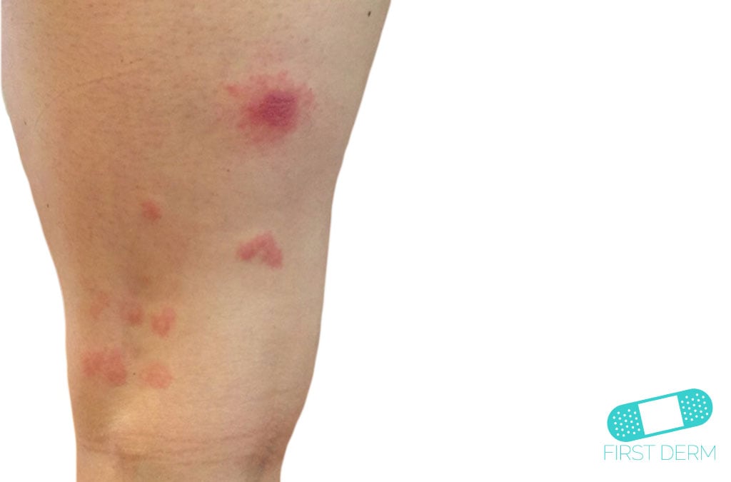 Online Dermatology Insect Bite