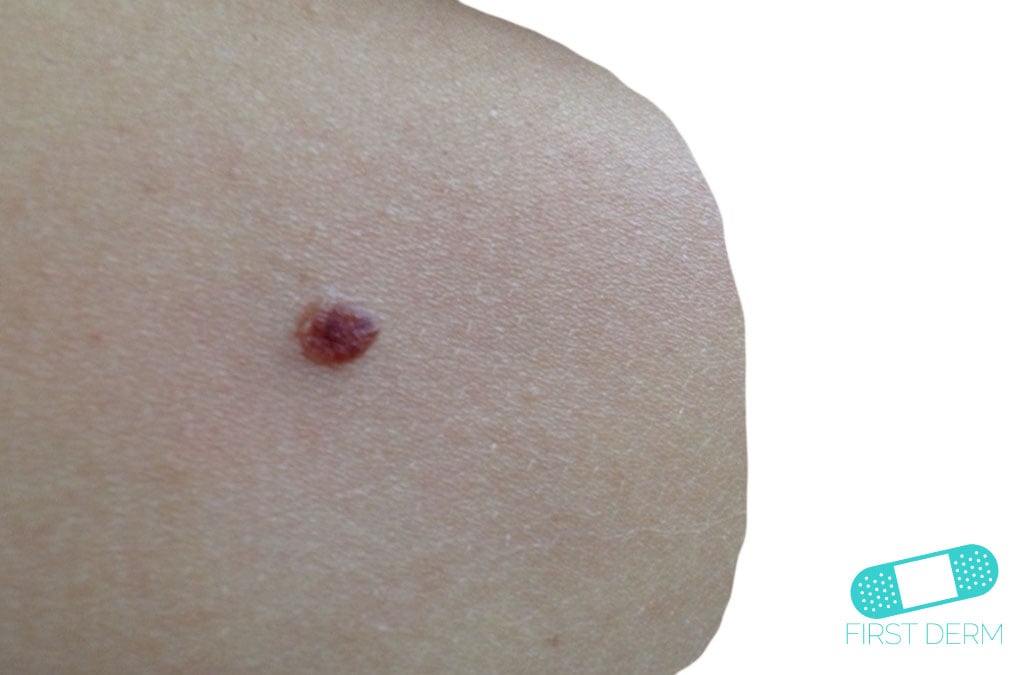 Intradermal nevus Online Dermatology