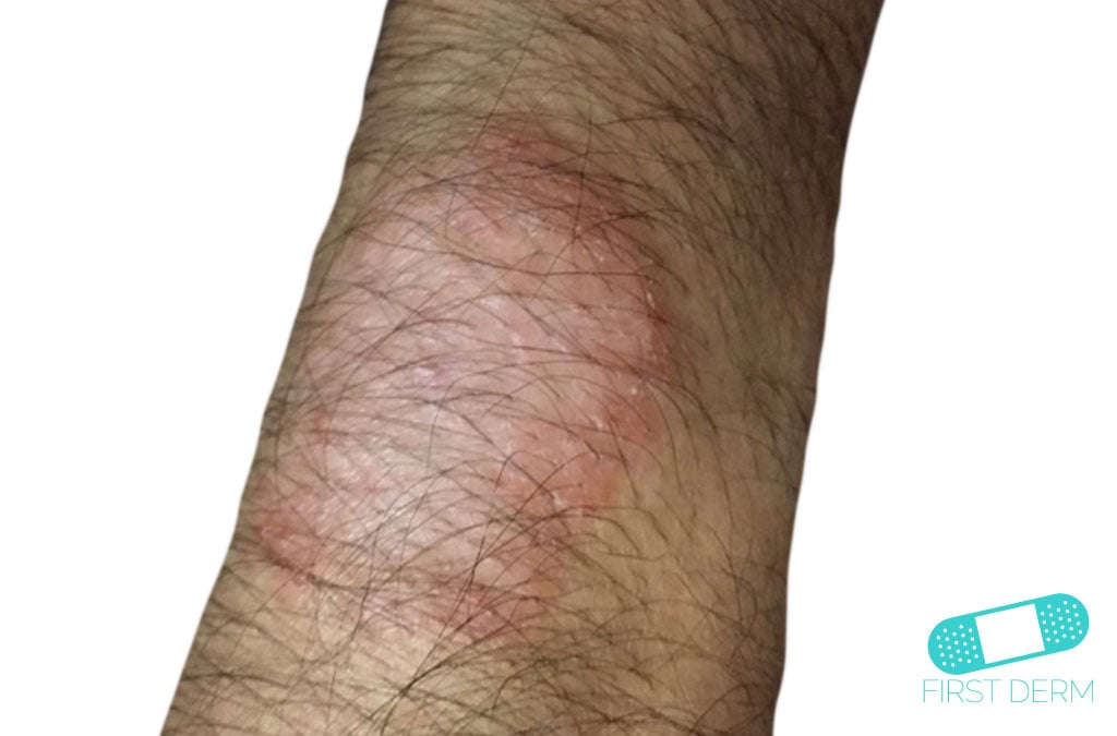 Hudläkare på nätet Neurodermatit