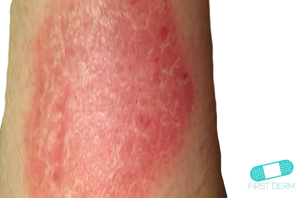 What Is The Icd 10 Code For Kepra Levels