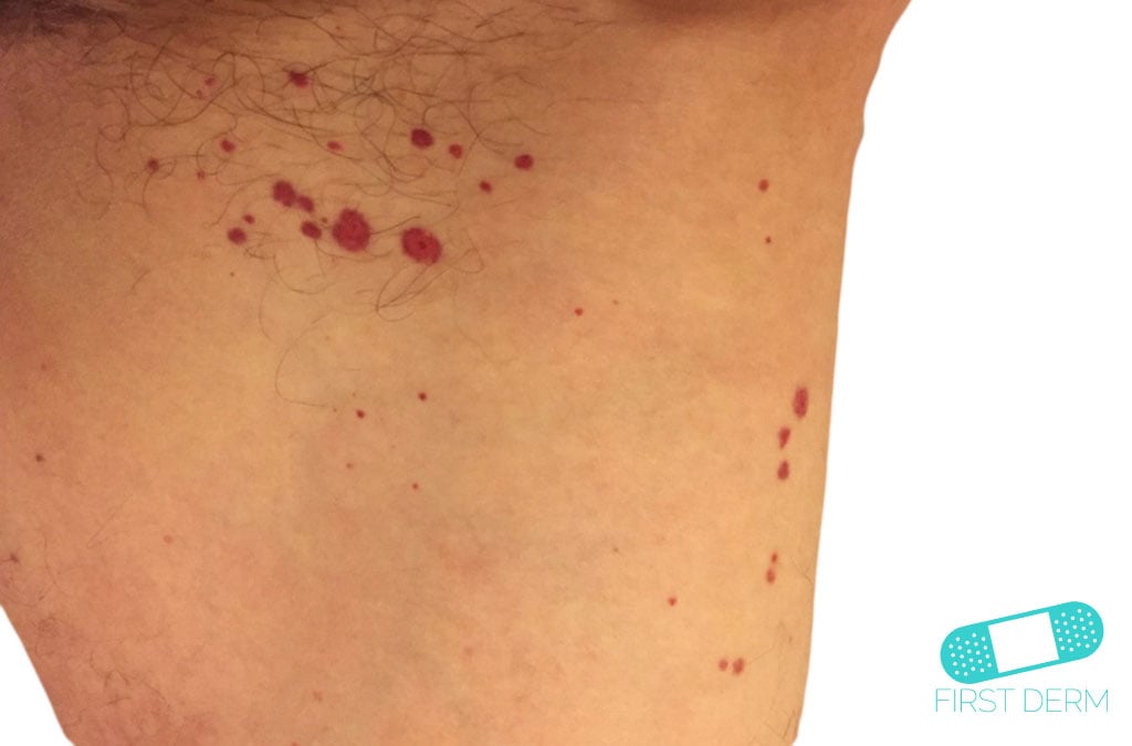 Online Dermatology Vasculitis (Leukocytoclastic Vasculitis)