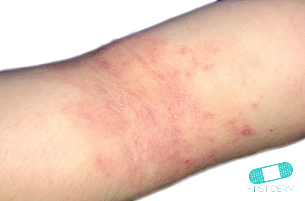 Online Dermatology Atopic Eczema