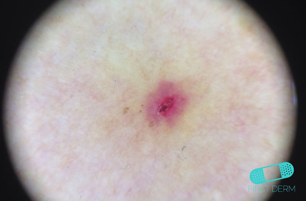 Online Dermatology Ulcer