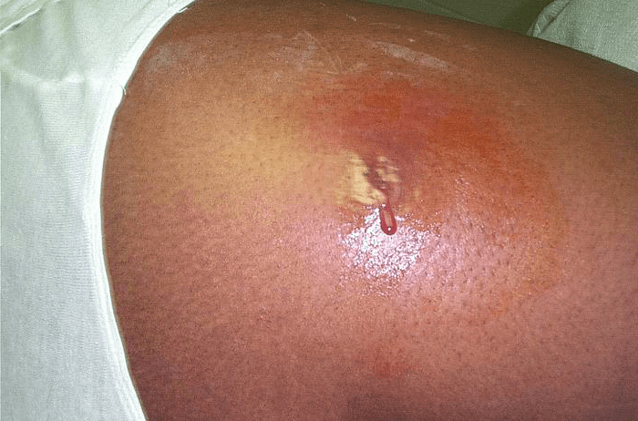 Abscess Online Dermatology