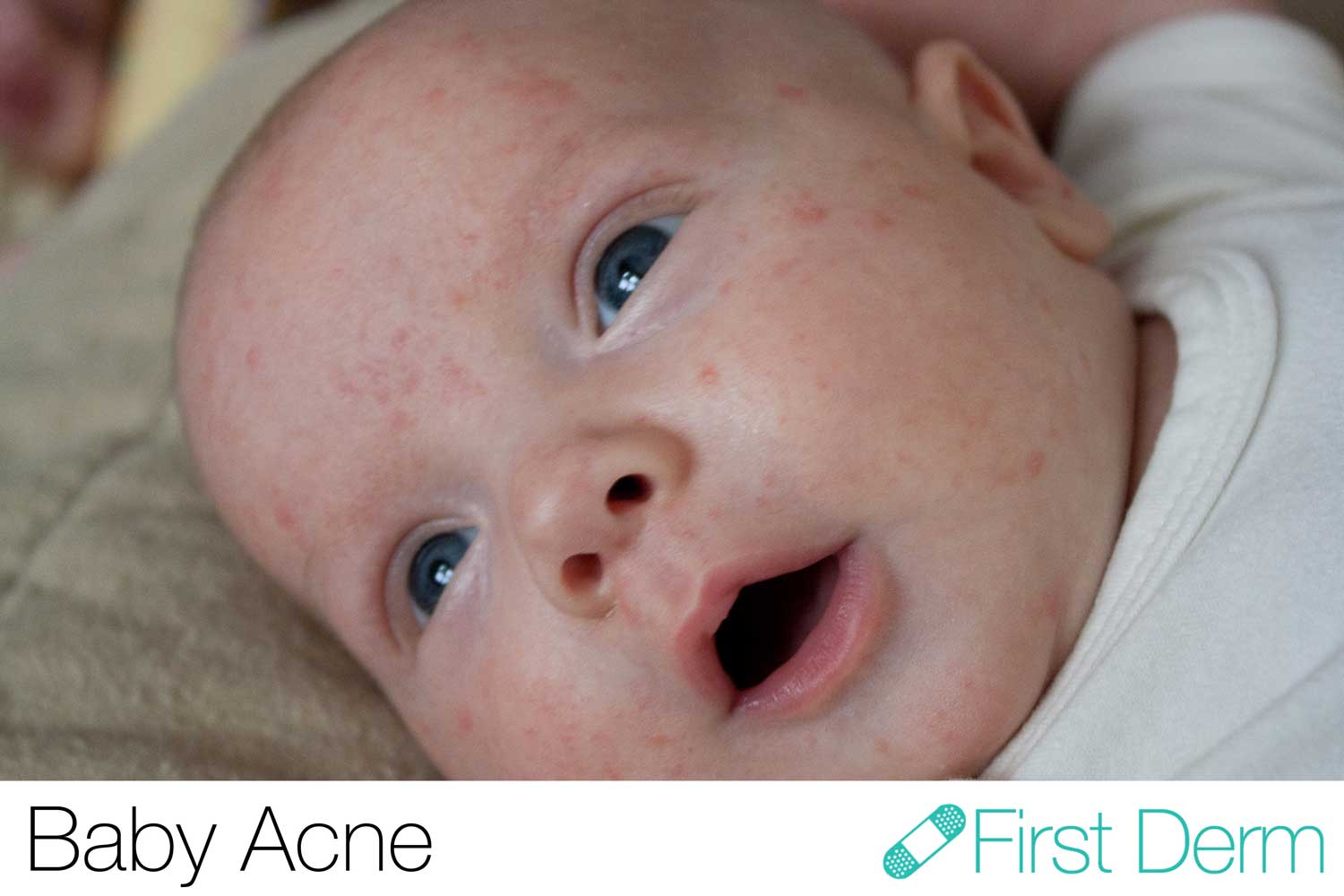 The Top 5 Newborn Skin Conditions