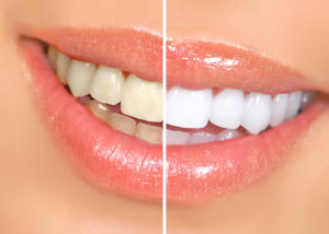What To Eat, What Not To Eat After Teeth Whitening In Greensboro - David M. Fisher, Jr. Dds Blog