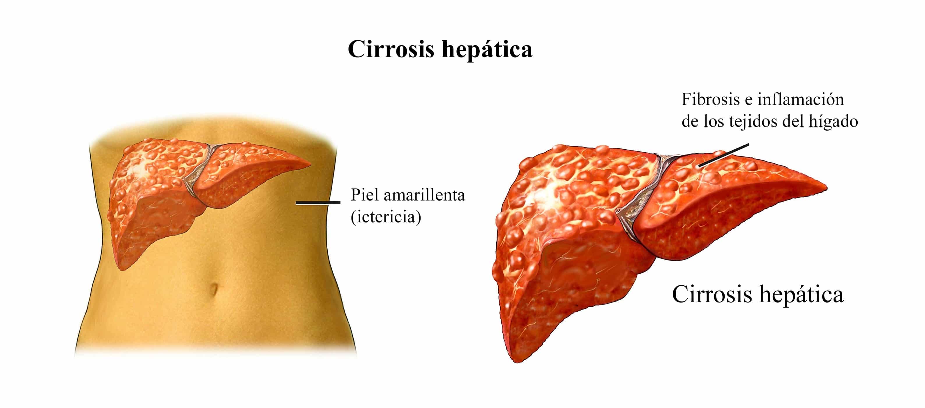 Esteatosis hepática, síntomas, causas, leve, difusa, severa, alcohol