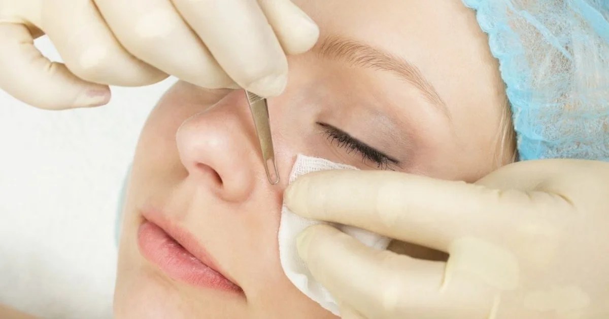 What Are Deep Blackheads And How To Safely Remove Them Fitneass