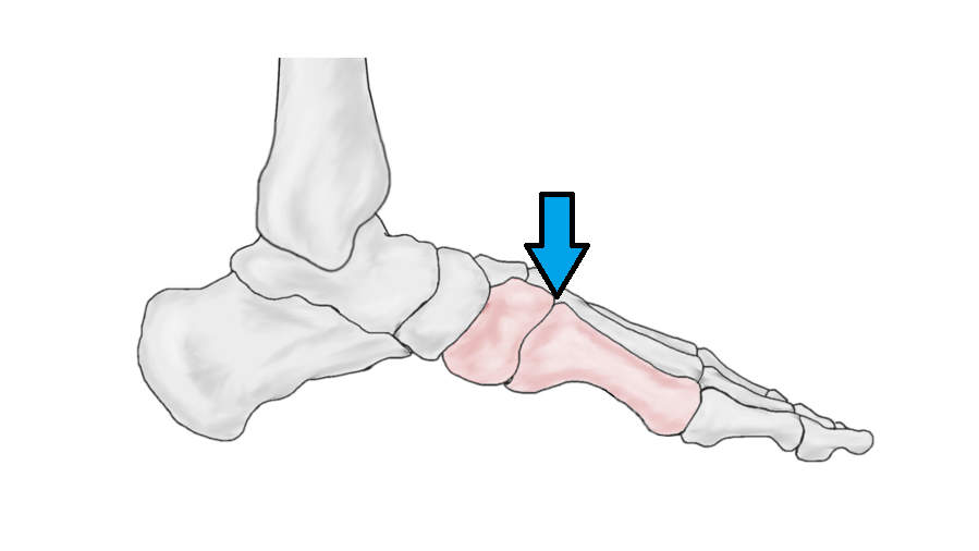 Exostosis On Top Of Foot