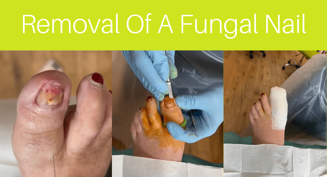 Story of a fungal nail removal
