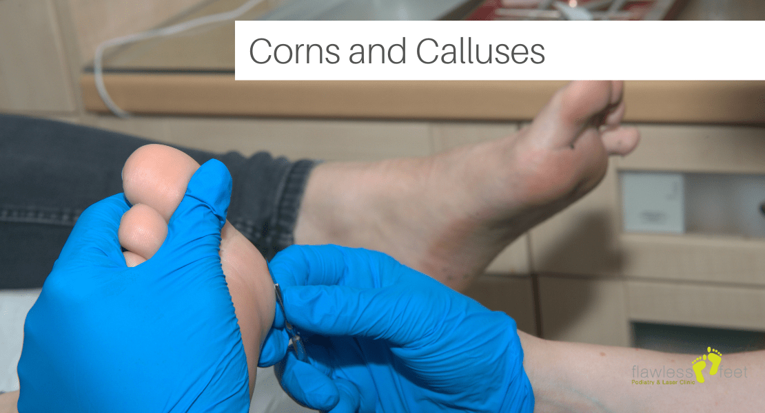Understanding Corns and Calluses on Feet Causes, Prevention, and Treatment