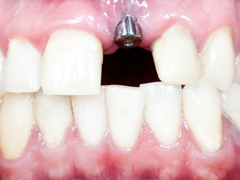 Periodontal abscess 24,000.00 Florida Dental Malpractice